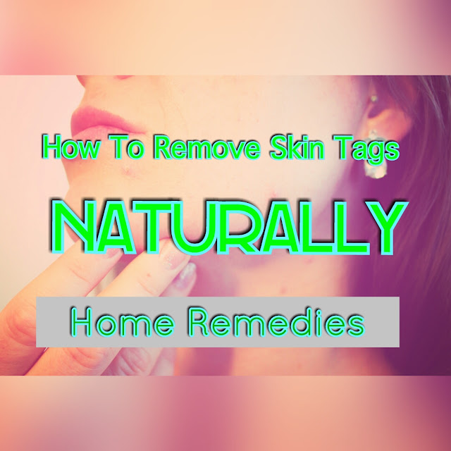 Home Remedies: How to Remove Skin Tags Naturally Home Remedies: How to Remove Skin Tags Naturally