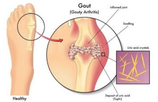 obat oles alami untuk asam urat, buah kersen obat asam urat, obat asam urat makanan, cara menyembuhkan asam urat secara alami, gambar penyakit asam urat, bir hitam asam urat, cara mengatasi asam urat pada lutut, apakah asam urat bisa bengkak, asam urat jika diurut, obat asam urat yang alami dan ampuh, gejala awal asam urat dan pencegahannya, ciri asam urat dan pengobatanya, obat herbal asam urat dan cara membuatnya, gejala asam urat dan penyebabnya, ciri asam urat dan obatnya, mengobati asam urat pantangan, obat alami untuk penyakit asam urat, bekam asam urat kaki, asam urat dalam bahasa medis, obat apotik penyakit asam urat, asam urat dan cara pengobatan, penyakit asam urat dan cara penyembuhanya, pemeriksaan kadar asam urat darah, obat asam urat yang aman, obat herbal darah tinggi kolesterol dan asam urat, penyakit asam urat dan cara mengatasinya, asam urat makan nanas, asam urat di leher, cara mengatasi asam urat sejak dini, asam urat pada anak muda