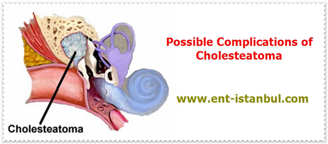 Cholesteatoma Complications