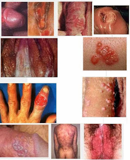 obat penyakit sipilis, obat penyakit sipilis,