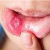 อันตราย!! โรคในช่องปาก ไม่รักษาเสี่ยงกระทบอวัยวะภายใน ปอด – หลอดลม !!