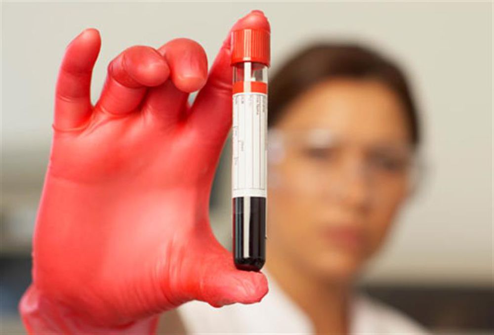 Medical Laboratory and Biomedical Science New Blood Test for Active