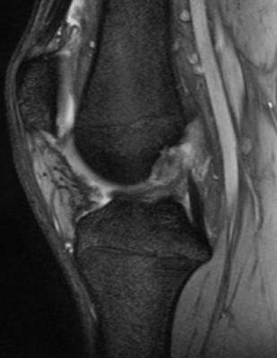 Twisting injury of the knee: torn anterior cruciate ligament (ACL) and medial meniscal bucket-handle tear