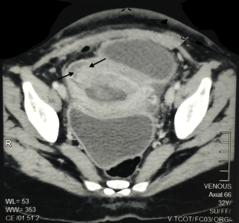 Journal of Postgraduate Gynecology & Obstetrics Postoperative Lower