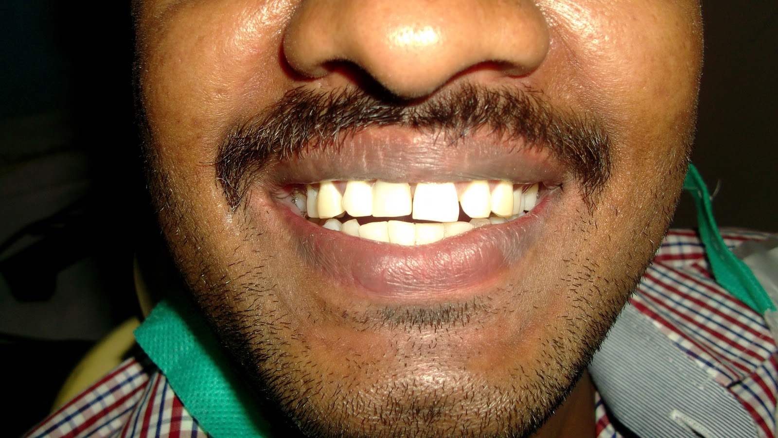 Problems with Removable Partial Denture