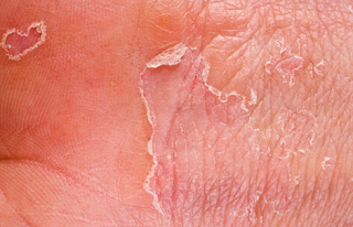 Obat Eksim Kering Menahun Tradisional di Apotik