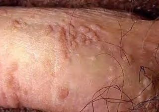 Foto Pengobatan Jamur Kutil Kelamin Membunuh Virus Kutil