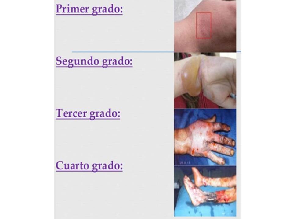 Quemaduras De Tercer Grado