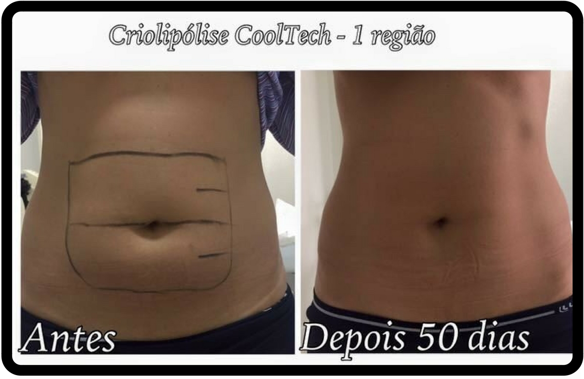 Criolipólise - Acabe com a Gordura Localizada em UMA Sessão