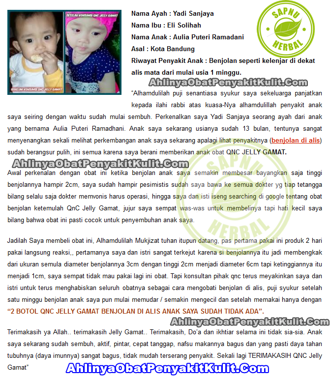 Obat Benjolan Di Langit Langit Mulut Terampuh Tanpa Operasi !! Obat Benjolan Di Langit Langit Mulut Terampuh Tanpa Operasi !!