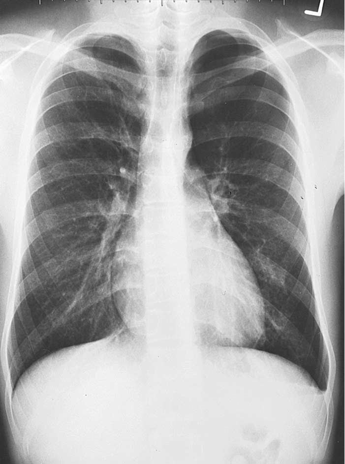 Chest X Ray In Pneumothorax