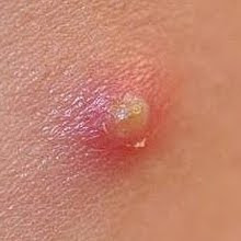 THIS IS THE MASTER PIMPLE... DRAG IT OFF AND USE IT IN YOUR PIMPLING PIMP-OUT