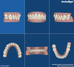 Projected 3D Images - End of Invisalign