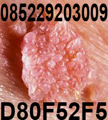 kutil kelamin obat kutil kelamin de nature indonesia