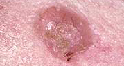bessie-bessi-basalcellscancer
