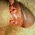 Obat Kutil Kelamin Pria thumbnail
