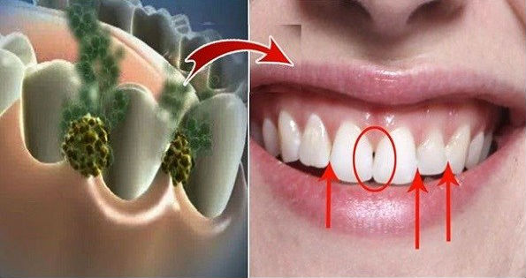 Cara Hilangkan Bau Mulut dan Semua Bakteri dalam 5 Menit