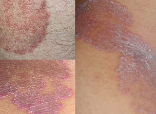 Image SALEP OBAT GATAL HERBAL UNTUK ALERGI DERMATITIS ATOPIK