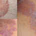 NAMA OBAT UNTUK GATAL DERMATITIS SEBOROIK