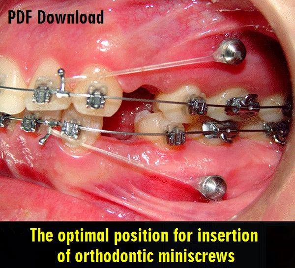 PDF The optimal position for insertion of orthodontic miniscrews