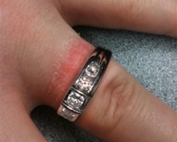 Почему палец черный от золотого кольца. Аллергия на серебро кольца. Аллергия на серебряное кольцо.