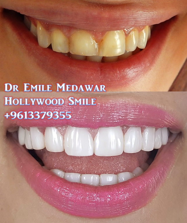 Veneers Style, Dr Emile Medawar, 00961 3 379355 Dental Veneers by Dr