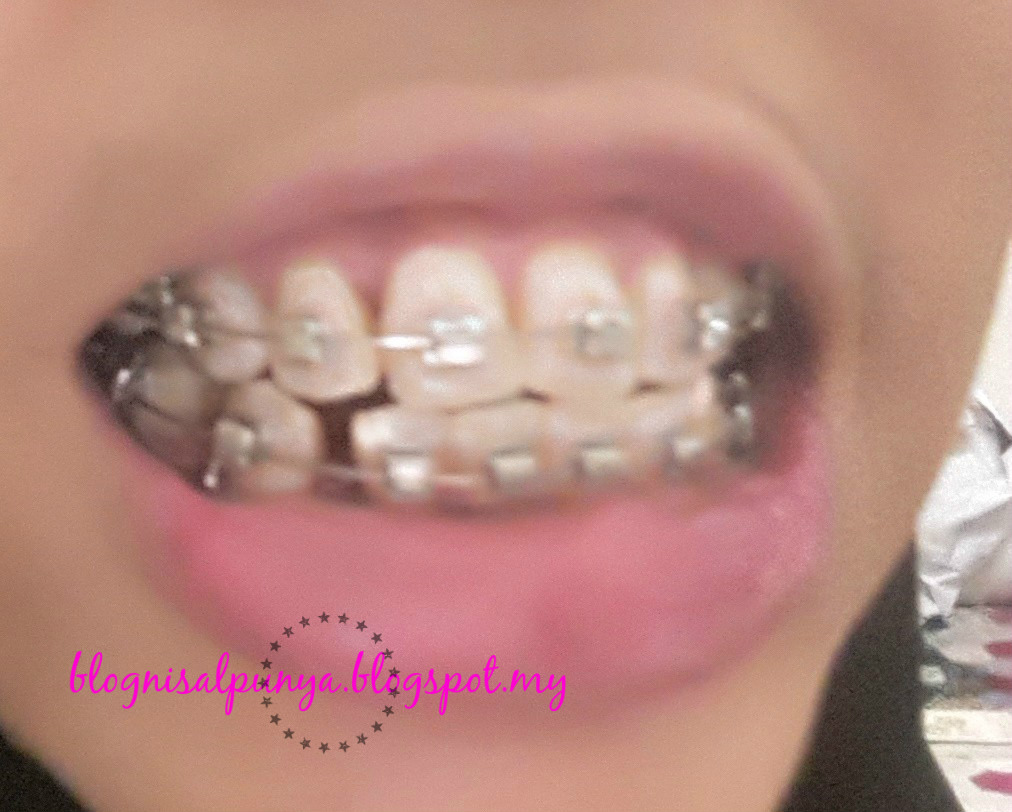 Blog Sal Braces Journey Part 8 Cabut braces!!!