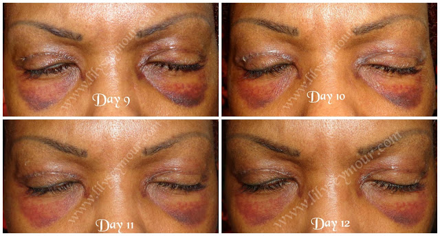 African American Ethnic Blepharoplasty (Eyelid Surgery) Day 9 - Day 12