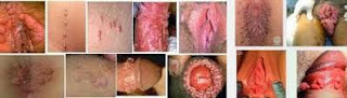 Obat Kutil Kelamin Di Jamin Sembuh Total