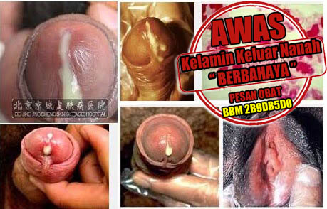 Pengobatan Kencing Nanah Gonore Ampuh Sembuh Total Pengobatan Kencing Nanah Gonore Ampuh Sembuh Total