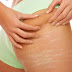 10 Home Remedies to Cure Buttocks/Hips Stretch Marks