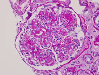 infection glomerulonephritis renal occurring