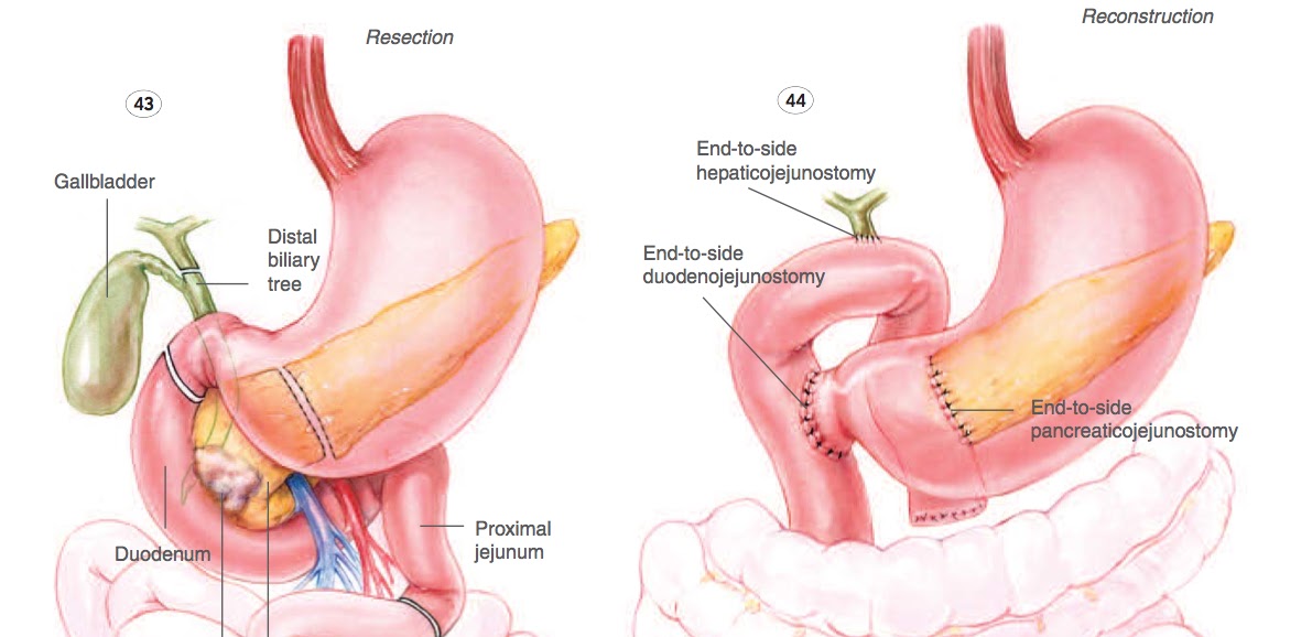 Earthwide Surgical Foundation WHIPPLE