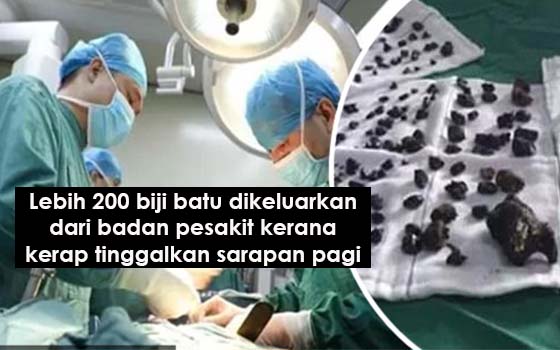 PADAH KERAP TINGGAL SARAPAN PAGI, DOKTOR TEMUI 200 BIJI BATU DALAM BADAN PADAH KERAP TINGGAL SARAPAN PAGI, DOKTOR TEMUI 200 BIJI BATU DALAM BADAN