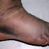 Ankle & Feet Swelling Ayurvedic Treatment at Home