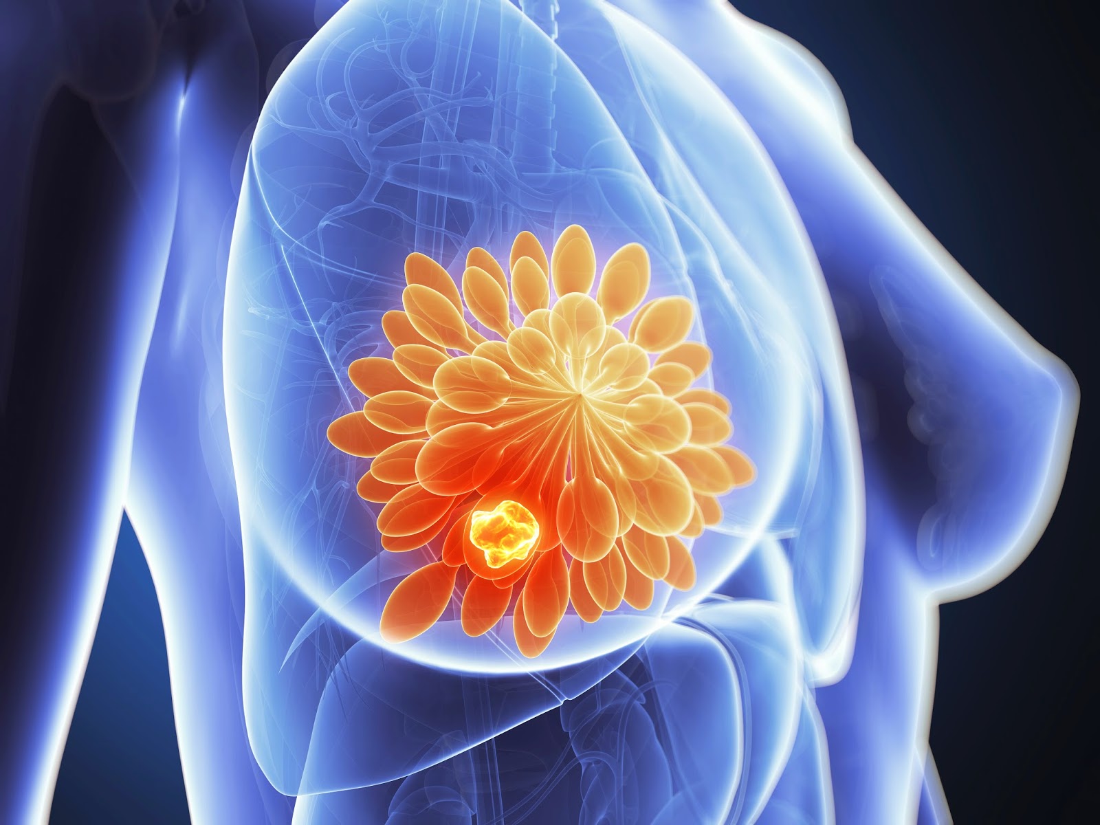 Cancer de mama cirugia conservadora cuadrantectomia en guadalajara biopsia Cancer de mama cirugia conservadora cuadrantectomia en guadalajara biopsia