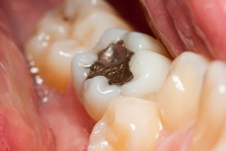 Quá trình trám răng mất thời gian bao lâu