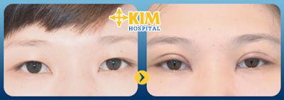 Tại KIM Hospital, bạn không phải quá lo lắng cắt mắt 2 mí giá bao nhiêu và có thể yên tâm về chất lượng dịch vụ nhận được.