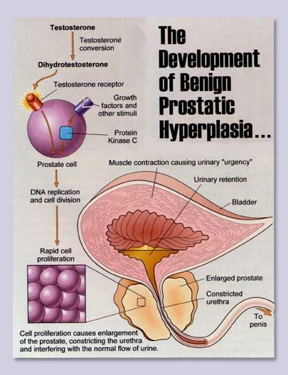 prostatitis a louise széna