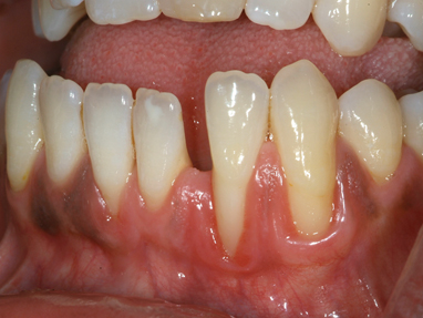 severe calculus buildup in mouth severe calculus buildup in mouth
