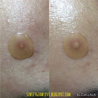 3M Nexcare Acne Patch before and after
