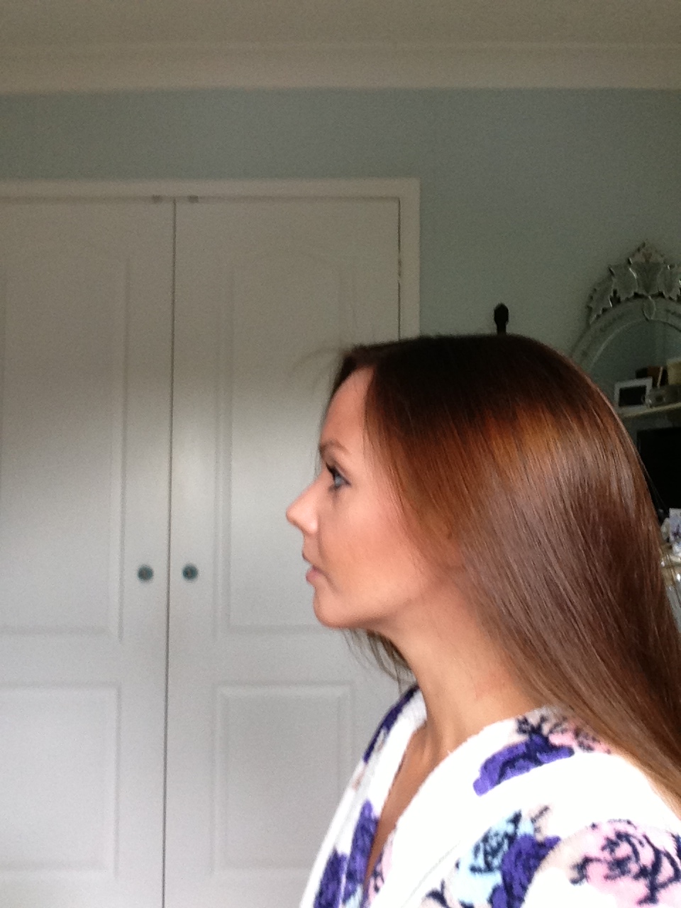 Before And After Braces Before And After Braces Side Profile