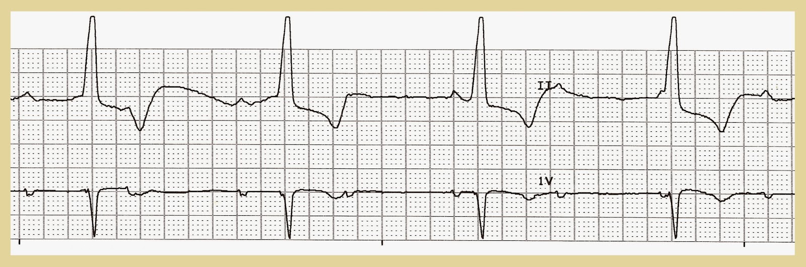 EKG Rhythm Quiz 231