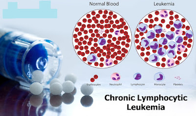 Venclexta/venetoclax Cost, Side effects, Uses for chronic lymphocytic leukemia