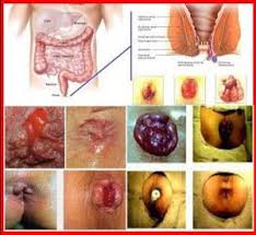 Foto Obat Ambeien Selain Ambeven Di Apotik Umum