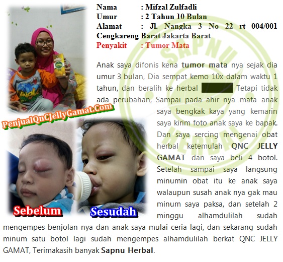 Cara Mengobati Kelopak Mata Bengkak Dan Gatal Secara Alami Terbukti Manjur ~ TESTIMONI QNC JELLY GAMAT Cara Mengobati Kelopak Mata Bengkak Dan Gatal Secara Alami Terbukti Manjur ~ TESTIMONI QNC JELLY GAMAT