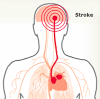 Obat Stroke Alami, Ampuh Menyembuhkan Stroke dg Aman Tanpa Efek Samping Obat Stroke Alami, Ampuh Menyembuhkan Stroke dg Aman Tanpa Efek Samping