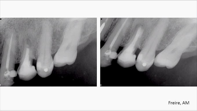 CASO CLÍNICO: Endodontia cirúrgica dente 24 com reabsorção apical associação ultrassom com Endogel