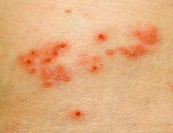 Έρπης ζωστήρας Όλα όσα θέλετε να ξέρετε