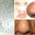 How To Get Rid Of Blackheads For Good DIY Blackheads Face Mask